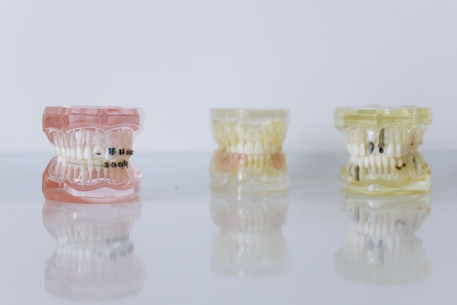 Invisalign · יישור שקוף קיסריה